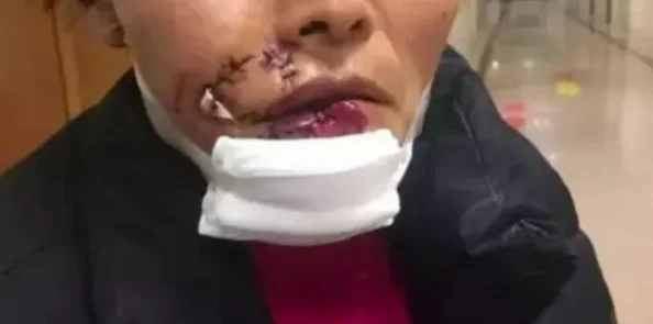 浙江一女子被狗撕碎左脸，缝了500多针！警方已介入调查